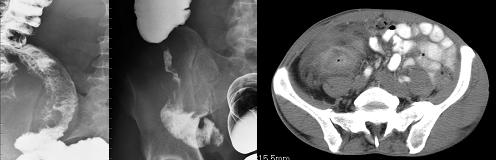 6 Doença de Crohn ileo-cecal em fase quiescente - Ligeiro espessamento parietal ileo-cecal, sem alterações significativas da gordura adjacente (TC).