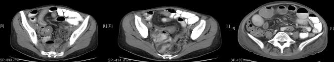 A B C Fig. 7 Doença de Crohn ileal. A e B Fase activa com o sinal do pente e estratificação mural do íleon distal (TC). C Mesmo doente, 8 meses depois.