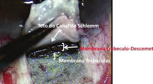 fibrose conjuntival precoce, necessitando de um tratamento apropriado.