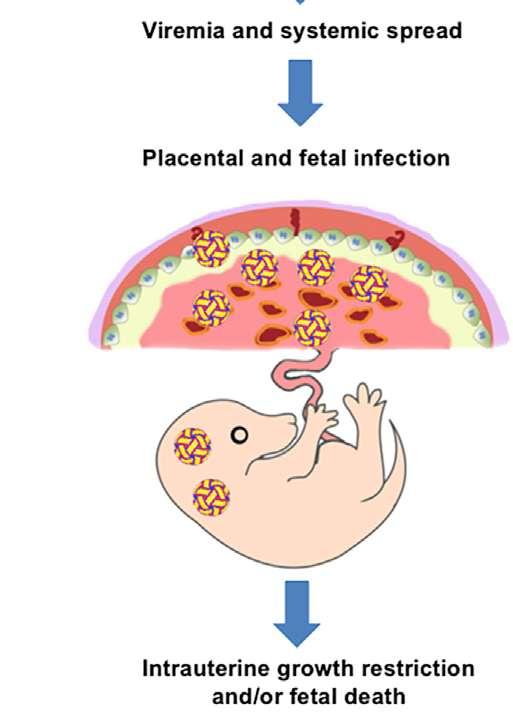 Infecção na placenta