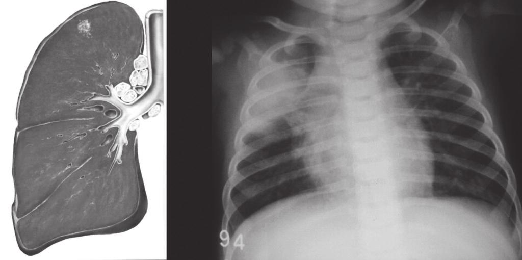 Controle da Tuberculose: uma proposta de integração ensino-serviço Figura 2 Complexo primário focos pulmonar e lifonodal Fonte: Chibante; Hijar (2007).