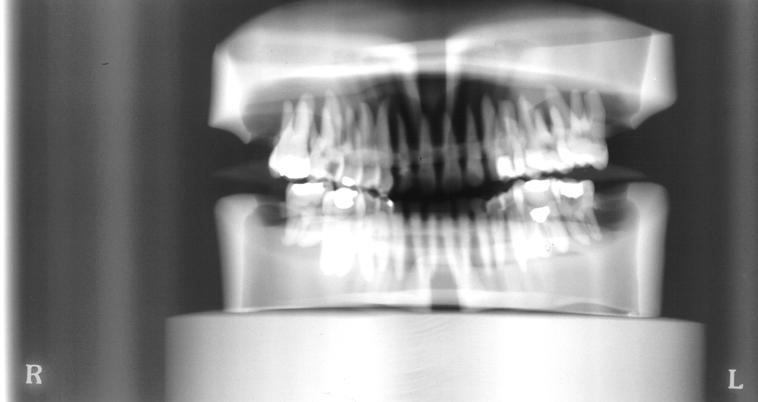 37 FIGURA 9 Radiografia do manequim no aparelho radiográfico panorâmico PANOURA 10 com plano oclusal