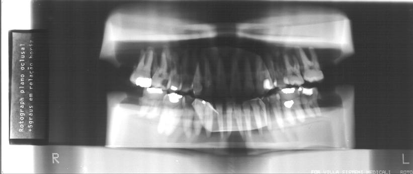 FIGURA 12- Radiografia do manequim no aparelho radiográfico panorâmico