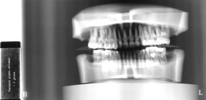 39 FIGURA 13- Radiografia do manequim no aparelho radiográfico panorâmico