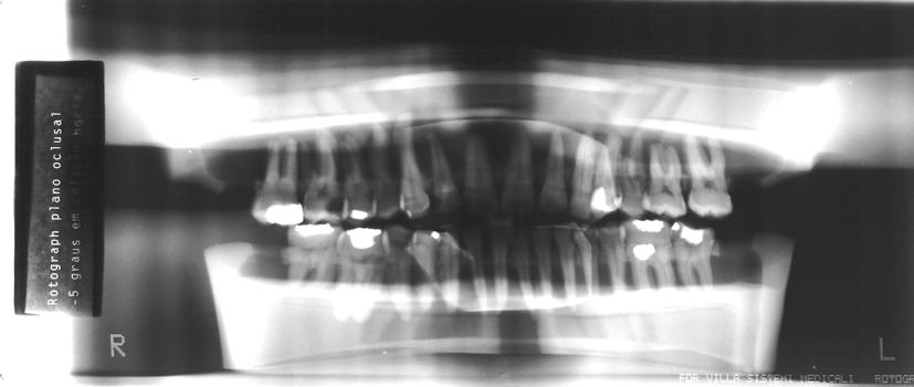 FIGURA 14- Radiografia do manequim no aparelho radiográfico panorâmico