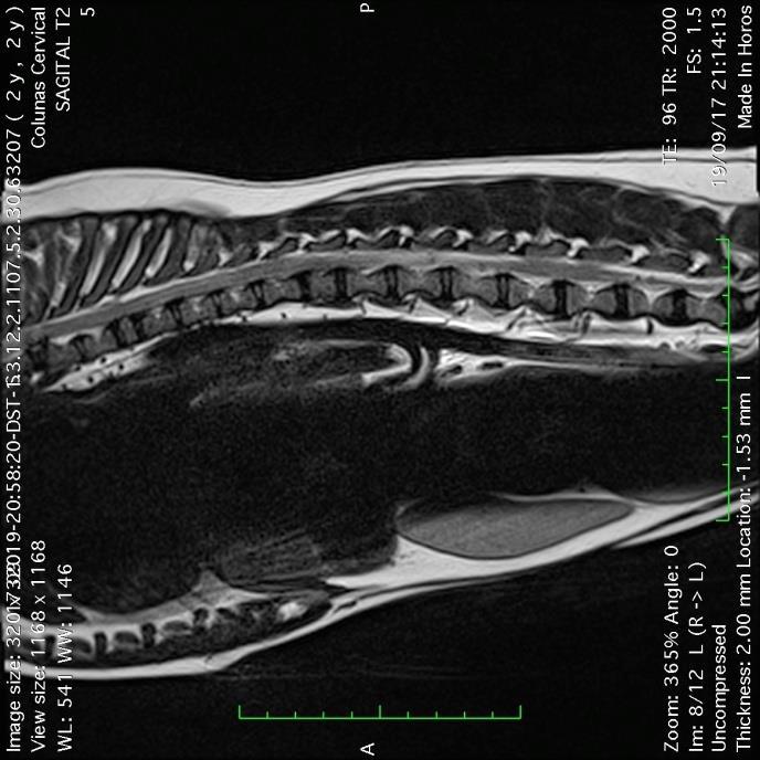 18 Figura 2 - Ressonância Magnética da coluna vertebral torácica caudal e lombar. A: Imagem ponderada em T2, setas indicam àrea de hiperintesidade medular em L1-L2.