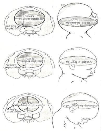 DIMENSÕES DO PÓLO CEFÁLICO circunferências occipito-mentoneira (OM) =