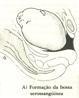 MOLDAGEM DA CABEÇA FETAL Capacidade de alterar