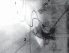 Figura 1 - Visão radioscópica do ventrículo direito em OAE, que se encontra contrastado, durante punção pericárdica.