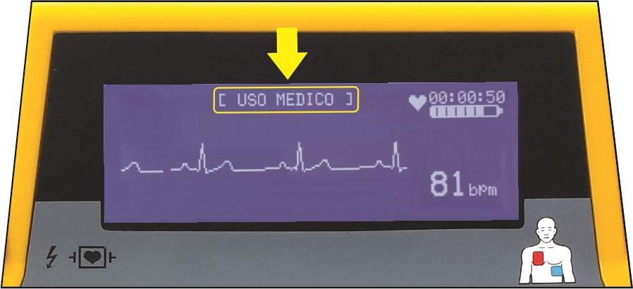 7 OPCIONAIS MODO MÉDICO A avaliação clínica do eletrocardiograma do paciente (ECG) e a decisão de aplicar ou não o choque é determinado pelo socorrista médico.