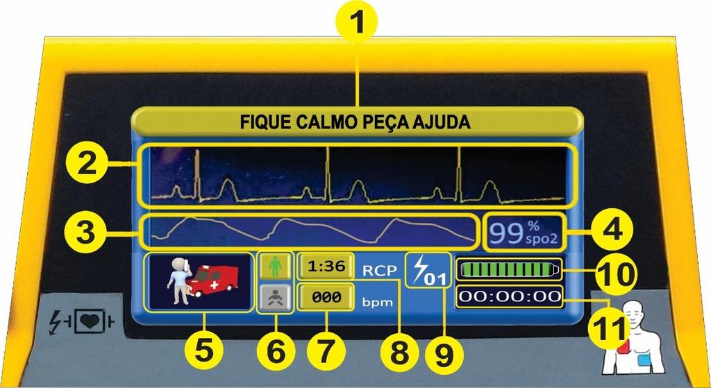DISPLAY COLORIDO 1 Comando de texto. 2 Curva de ECG. 3 Curva de oximetria. 4 5 Ícones de medidas a serem tomadas pelo operador. 6 7 Indicador de batimentos por minuto do paciente.