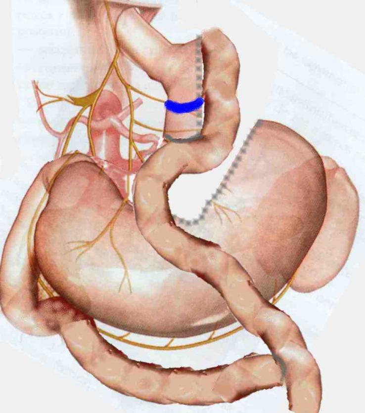 Tratamento Cirúrgico Cirurgia Bariátrica Diversas técnicas Banda Gástrica Ajustável