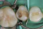 Compatível com todos os adesivos convencionais Casos clínicos As restaurações nos dentes 14 e 15 devem ser substituídas devido às cáries secundárias Fonte: Dr.