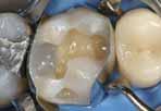 0,25 g cada, cor universal Dispenser Caps (Compômeros) Adesivo (ORMOCER ) (Compósito) Caso clínico No dente 26, a