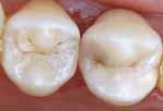 (splint) de dentes anteriores com mobilidade Combina as vantagens de compósitos com carga de micro e macro partículas Facilmente compactável, boa manipulação