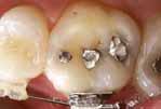 dentes decíduos Restauração de cavidades causadas por lesões cariosas