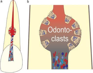 Figura 1. (a) Desenho esquemático mostrando a patogênese da reabsorção radicular interna inflamatória. A cavidade reabsortiva contém tecido de com células clásticas.