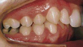 Em relação à cor, apenas o dente 46 apresentava lesão branca no
