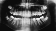 EXAME RADIOGRÁFICO Com exceção dos terceiros molares superiores e inferiores, que estavam em processo de formação, todos os demais dentes encontravamse erupcionados e bem formados (Figura 3).