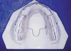 modificado, travando os dentes superiores) (Figuras 6 e