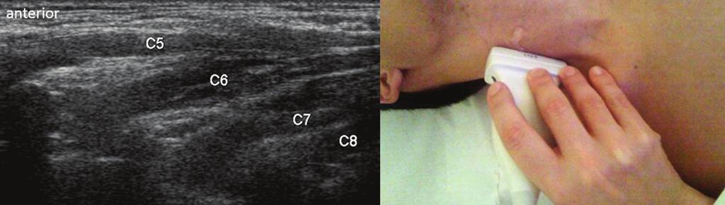US no plano transversal mostrando a raiz de C7 (seta) e o processo transverso posterior (traçado