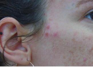 potencial de formação de acne in vivo.