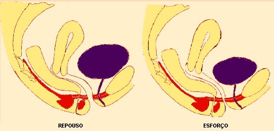 rvar que, no repouso, a JUV e a uretra proximal estão acima da musculatura do assoalho pélvico. No esforço, a JUV e a uretra proximal ficam abaixo. Obs.