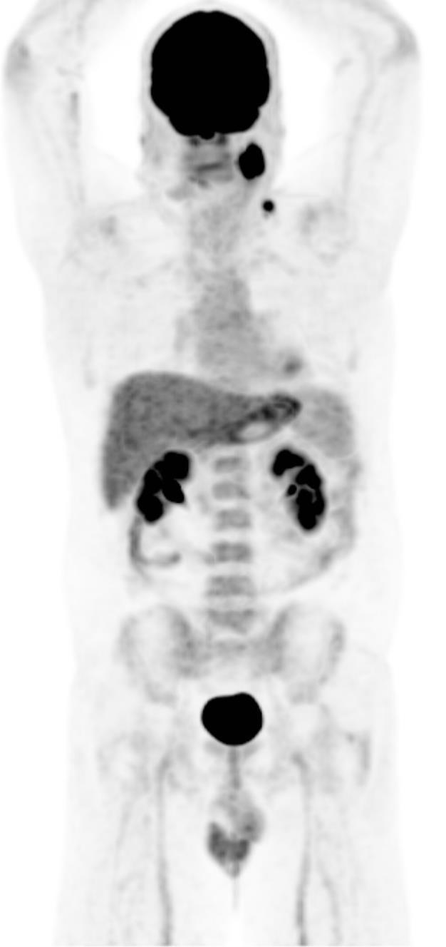 56 anos Carcinoma epidermoide do lábio