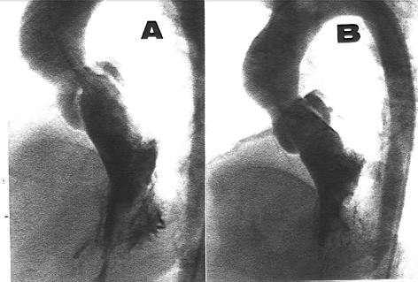Fig. 2 - Ventriculografia em projeção axial alongada antes e depois da dilatação. A) nota-se hipertrofia ventricular intensa e contração hipercinética. O anel aórtico tem dimensões preservadas.