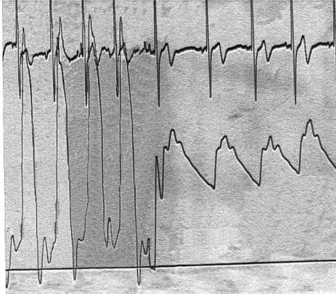 Arq Bras Cardiol de Log-rank. Foi determinado um valor p < 0.05 como estatisticamente significativo. Resultados Fig. 4 - Curvas pressóricas antes e depois do procedimento.