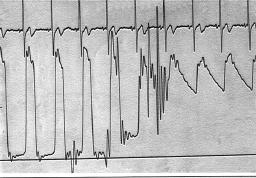 O padrão de curva na aorta não possui grande amplitude, sugerindo não haver insuficiência aórtica significativa.
