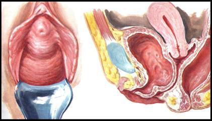 Defeitos vaginais posteriores (enterocele e retocele) (Figura 4 e 5) e defeitos