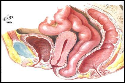 21 Figura 4 Enterocele com retocele e prolapso uterino. Fonte: SMITH, 2004.