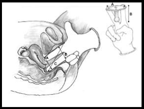 39 Além da melhora dos sintomas do prolapso pode se observar melhora da função da bexiga, intestino, função sexual e qualidade de vida em pacientes que utilizam pessários (THAKAR, 2014).