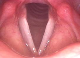 No geral, cânceres orofaríngeos podem apresentar os seguintes sintomas: dor constante, presença de nódulos, dificuldade para mastigar, dor na língua e mau hálito persistente.