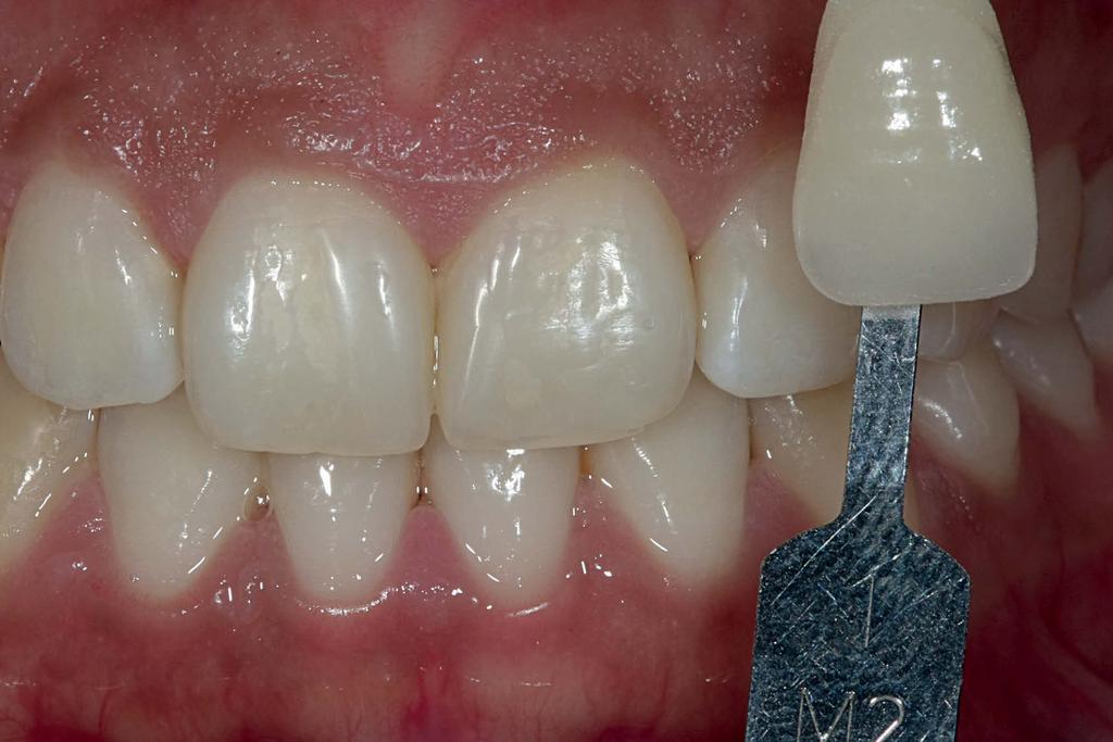Caso Clínico * Doutorando em Materiais Dentários, USP. ** Doutorando em Dentística Restauradora, UEPG.