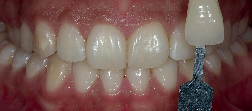 Garcia EJ, Kose C, Reis A, Loguercio AD superfície dos dentes. A paciente foi instruída a usá-lo durante o dia, por apenas 1 hora, após o uso do dessensibilizante.