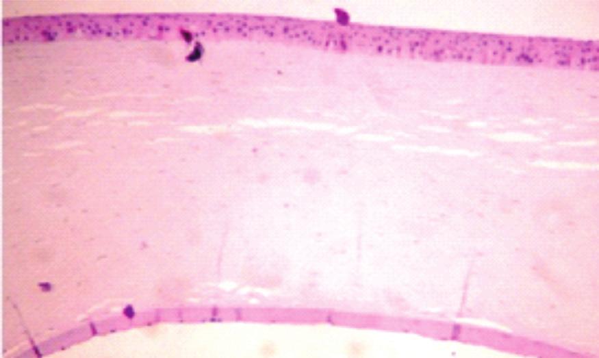 O papel da membrana de Descemet na patogenia do edema corneano após cirurgia de segmento anterior 263 INTRODUÇÃO Oedema corneano é uma condição clínica caracterizada pelo aumento da espessura ou do