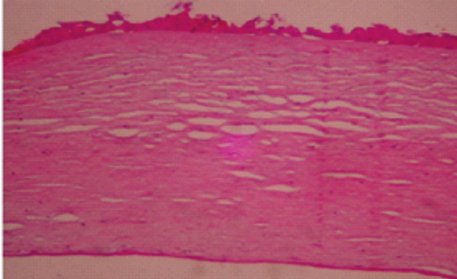 264 Ximenes KF, Silva JV, Vasconcelos KFX, Monte FQ Figura 1c: Edema moderado (grau III) mais generalizado, com espaçamentos ainda pequenos; microcistos podem ser vistos no epitélio Os critérios de