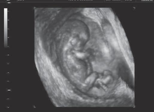 multiplanar, eixo ortogonal sagital em feto de dez semanas.