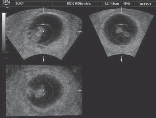 Comprimento cabeça-nádega na avaliação 3D volumétrica em feto