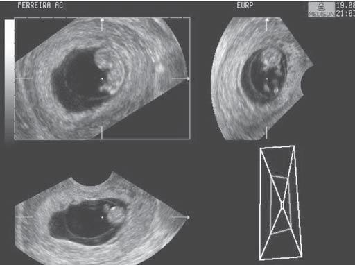 Saco gestacional na avaliação 3D volumétrica em gestação de