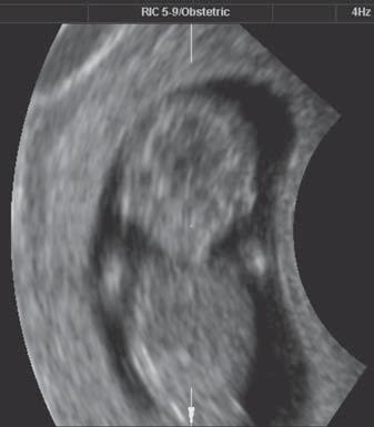 Perfil da face na avaliação 3D volumétrica em feto