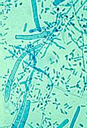 . A B C Figura 5: Característica da colônia de Trichophyton rubrum cultivada em meio Sabouraud ágar (A); e seus macroconídios e microconídios (B); Infecção do tipo tinea unguium (C). http://www.