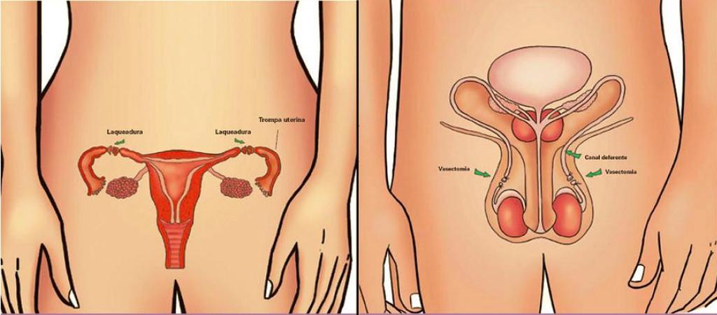 Métodos Cirúrgicos São métodos contraceptivos definitivos esterilização que podem ser realizados na mulher, por meio da ligadura