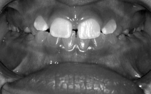 RELATO DE CASO 2 FIGURA 5: Radiografias periapical e bite-wing iniciais do caso 1 O plano de tratamento incluiu pulpotomias e/ou pulpectomias, cimentação de coroas metálicas pré-fabricadas nos