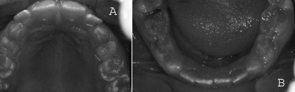 Verificaram-se também desgastes da superfície oclusais de todos os molares decíduos, incisais dos caninos decíduos e incisais dos elementos 31 e 32 (figuras 7A e 7B), ocasionando perda da dimensão