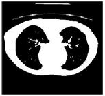 Segmentação de candidatos a Nódulo Pulmonar baseado em Tomografia Computadorizada Figura 1: Etapas da metodologia para a segmentação de candidatos a nódulos pulmonares.