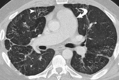 Doença Pulmonar Veno-oclusiva e Hemangiomatose Capilar Pulmonar 2. Hipertensão Pulmonar por Cardiopatia Esquerda 3. Hipertensão Pulmonar por Doença Pulmonar ou Hipóxia 4.