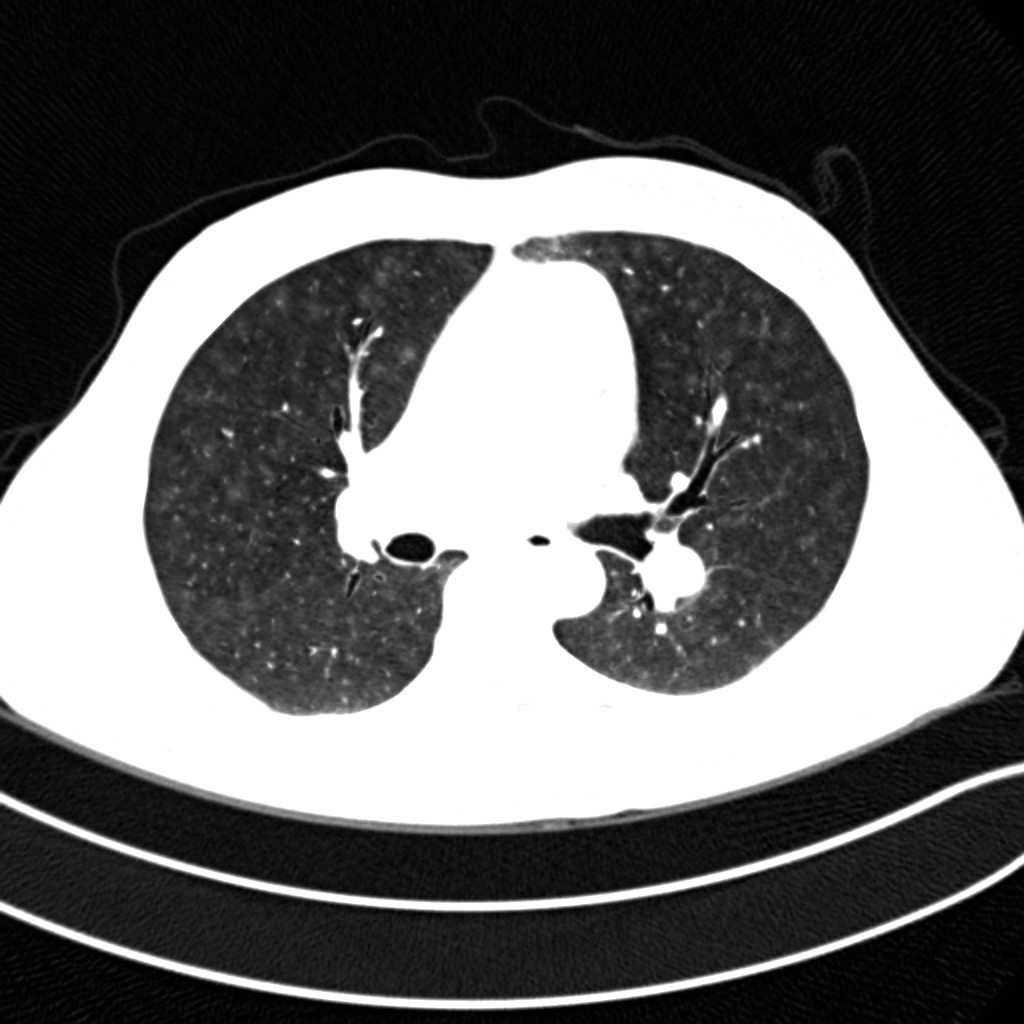 HEMANGIOMATOSE CAPILAR PULMONAR 1. Hipertensão Arterial Pulmonar(HAP) 1.1. Idiopática 1.2. Hereditária 1.3. Induzida por drogas ou toxinas 1.4.